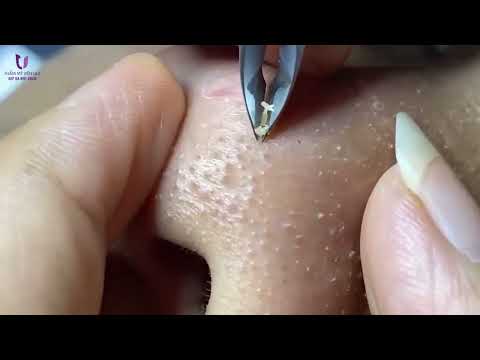Video XỬ LÝ MỤN CÁM & SỢI BÃ NHỜN Ở MŨI NHÌN SƯỚNG MẮT - youtube