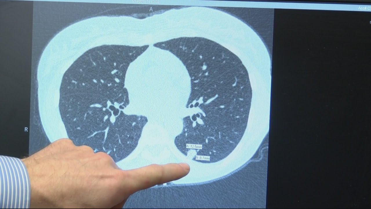 Former smoker beats number one cancer killer after minimally invasive surgery