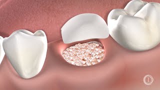 Post-Operative Instructions: Bone Grafting