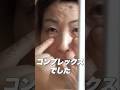 【クマ取り】59歳のクマ取り整形どうなる? #shorts #クマ取り#目の下のクマ #美容整形