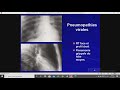 Cours 14 pneumologique  pneumopathies virales