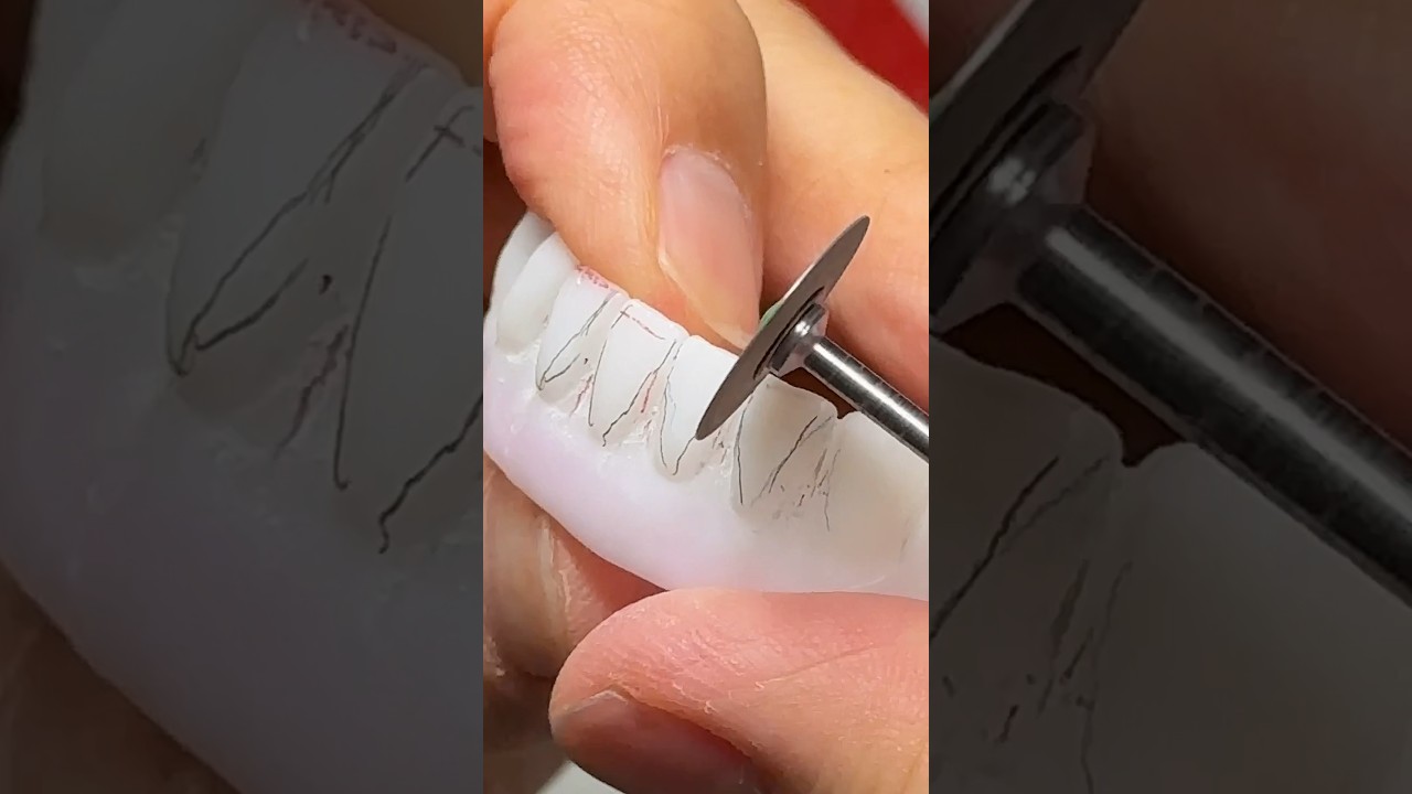 Zirconia Contouring!