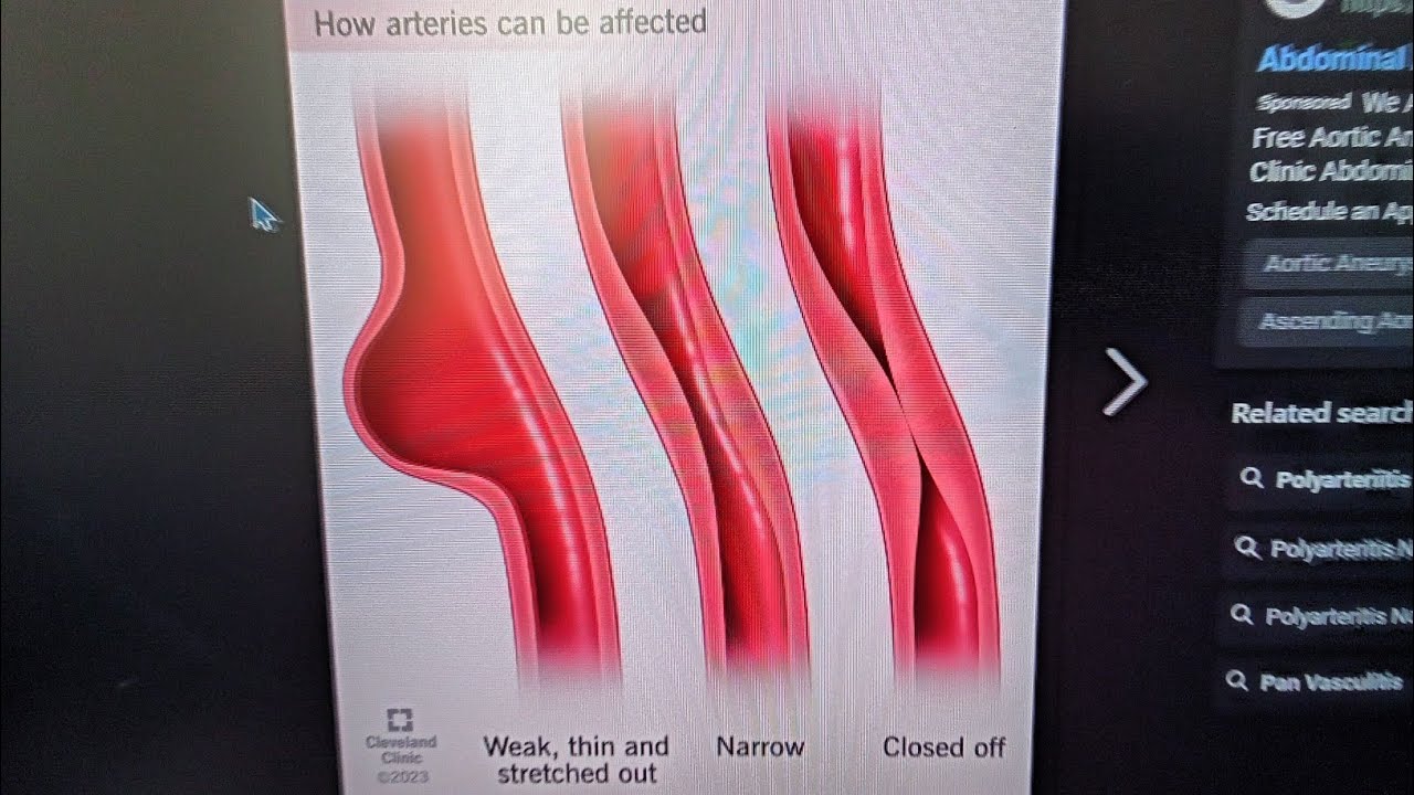 Mystery diagnosis polyarteritis nodosa and progussr Ireland Spain and japan