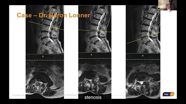 Identifying the Ideal VBO Patient: Clinical Decision Making with Dr. Baron Lonner & Dr. Sean McCance