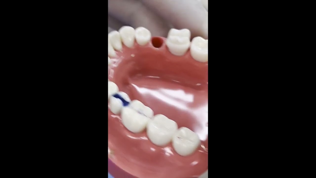 Class II Wax Up of a Mandibular Second Premolar Tooth