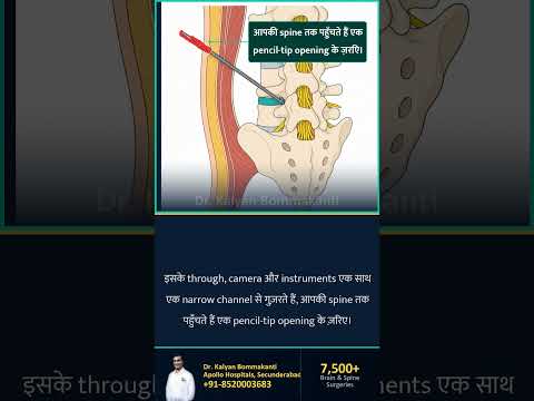 Monoportal या Biportal: कौनसा Keyhole चुनें? - Best Monoportal Endoscopic Spine Surgeon, Hyderabad