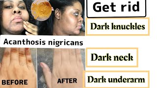 ..HOW TO GET RID OF *ACANTHOSIS NIGRICANS*DARK_KNUCKLES* DARK UNDER ARMS* HYPERPIGMENTATIONS ON FACE