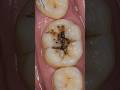 Heavy junk Teeth cleaning #teeth #teethcare #teethcleaning #teethwhitening