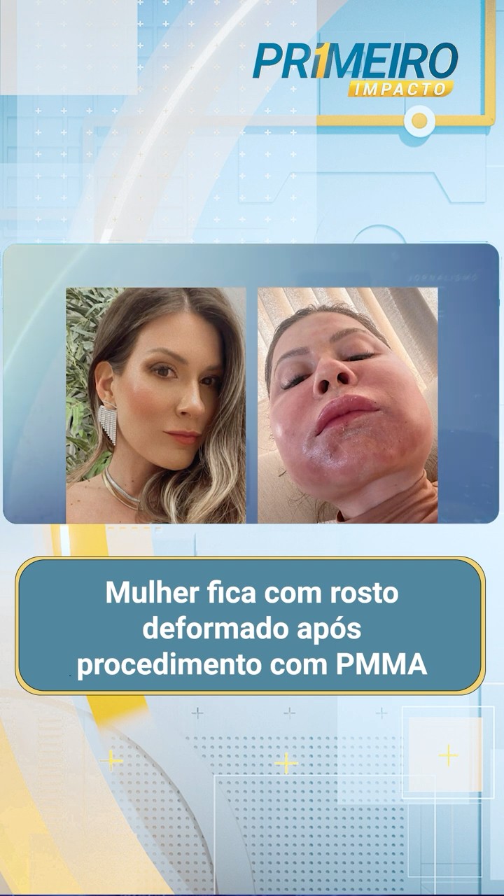 Mulher fica com rosto deformado após procedimento com PMMA