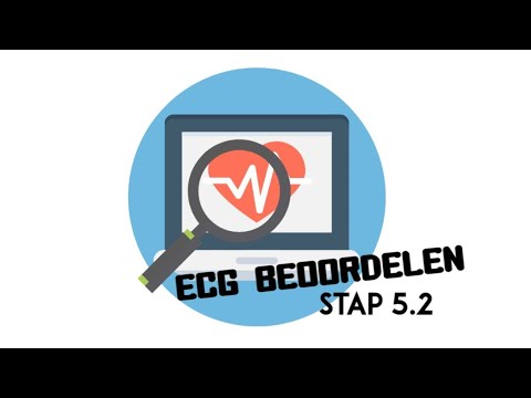 ECG beoordelen - stap 5.2 (QRS-morfologie)(R-top progressie)