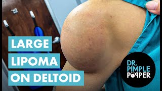 Large Lipoma on the Deltoid TAKES OVER Dr Pimple Popper's Day