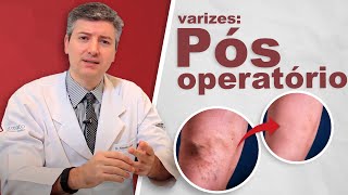 Como é o pós operatório da cirurgia de varizes? (laser e tradicional)