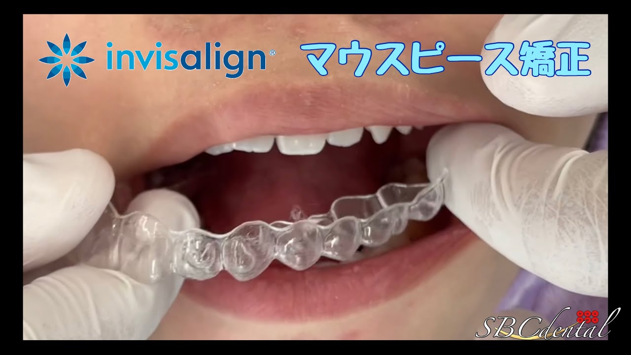【たった4ヶ月!】マウスピース矯正・インビザラインGOで歯並び綺麗に YouTube 【たった4ヶ月!】マウスピース矯正・インビザラインGOで歯並び綺麗に YouTube