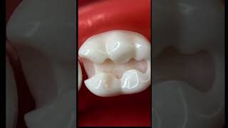 تعليم Cl Ii Cavity Preparation Lower 6