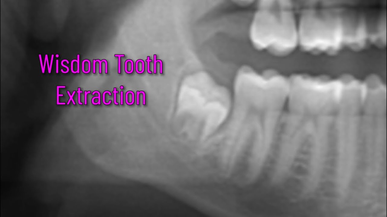 Wisdom Tooth Extraction with Incomplete Split - YouTube