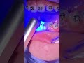 Getting my bottom braces - Bite Plate / Deep Bite - Tooth Time Family Dentistry New Braunfels