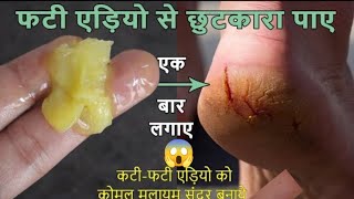 फटी एड़ियो से छुटकारा पाने का अचूक उपाय-Cracked Heels Home Remedy / Cracked Heels Treatment