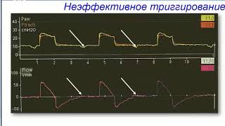 Асинхронии при ИВЛ Корякин А.Г.
