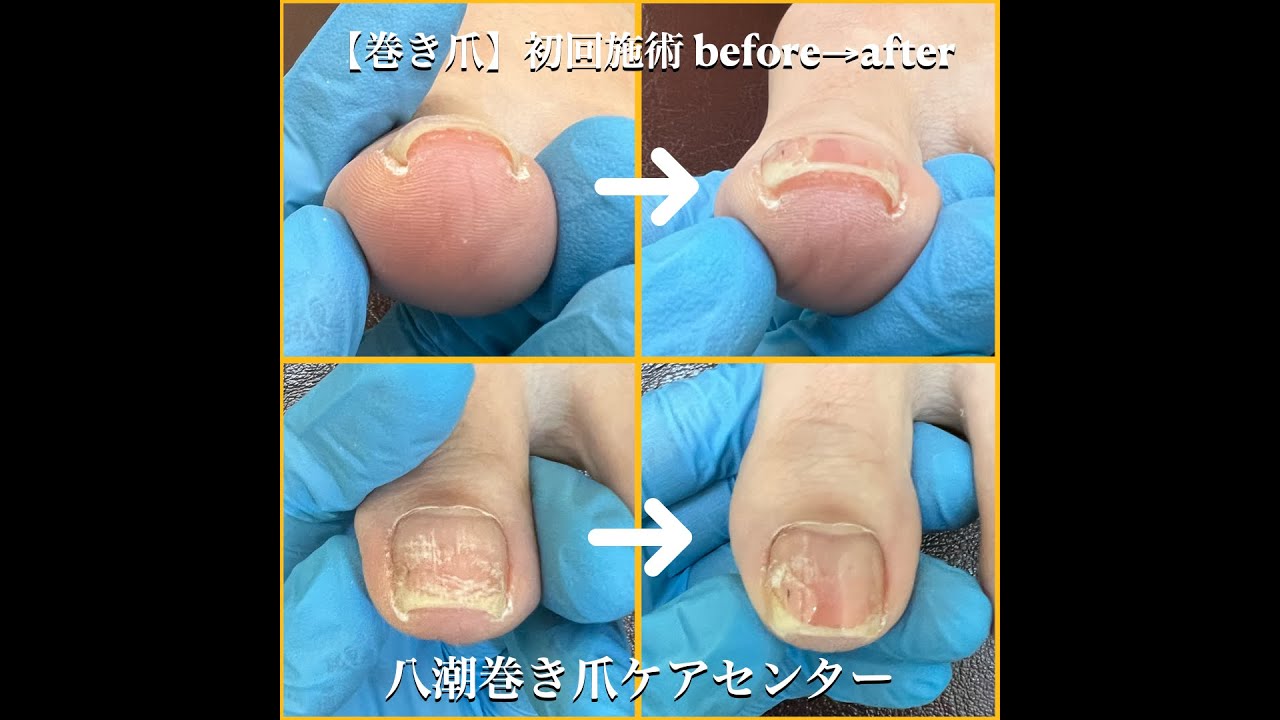 八潮巻き爪ケアセンター」医師や教授・専門家も絶賛の技術／TVでも紹介