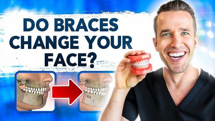How do elastic rubber bands for braces work? – Somos Dental