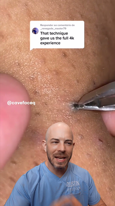 Clears out clogged pore in ONE satisfying pull👌#cloggedpores  #doctorreacts #satisfying #closeup