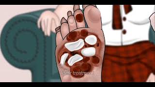athletes foot treatment  | treatment | asmr animation | satisfying video