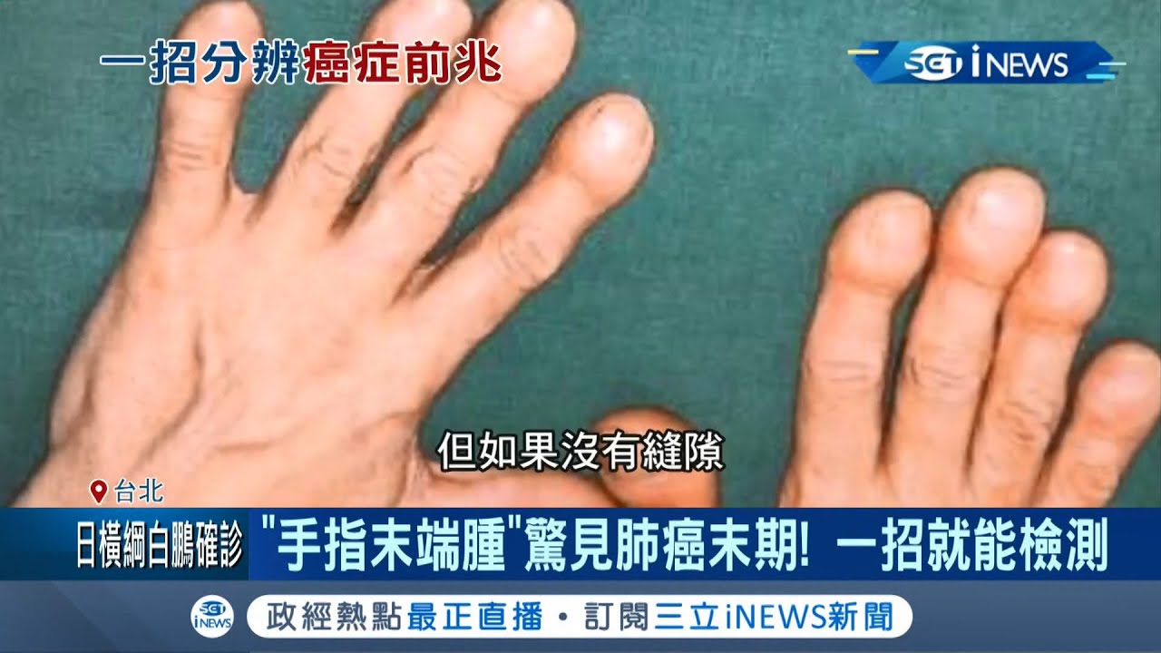 身體微恙是警訊！手指末端腫大恐為癌症前兆抬頭紋.耳垂皺紋可能是
