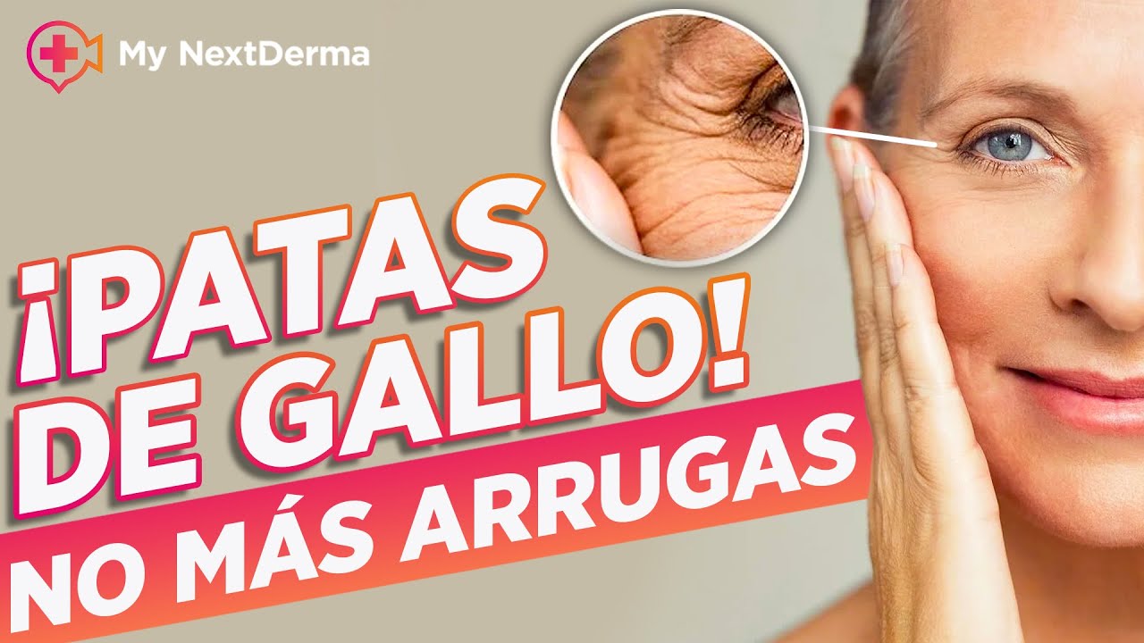 ¿PATAS DE GALLO? ¡TENGO TU Solución INMEDIATA! - YouTube
