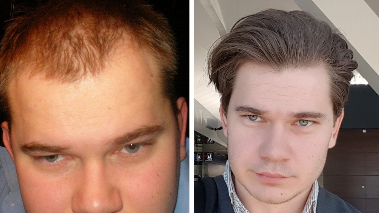 Does Detox Help With Hair Regrowth Treatment? YouTube