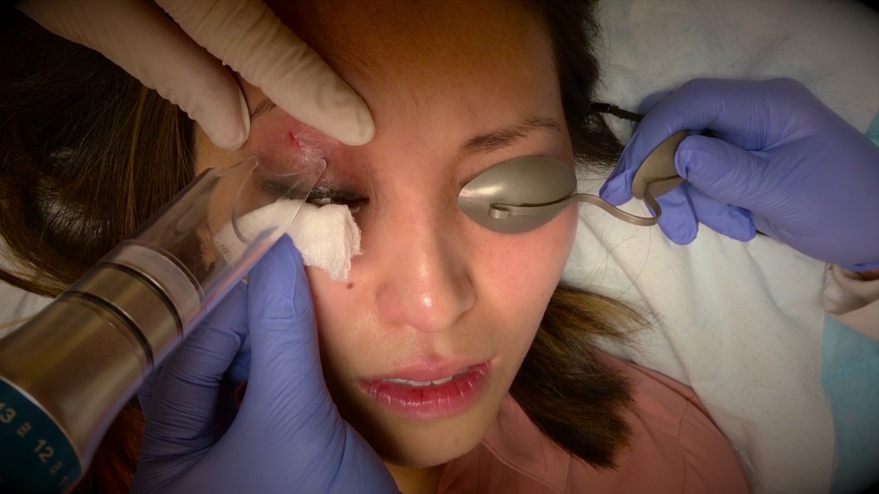 Permanent Makeup Removal YouTube