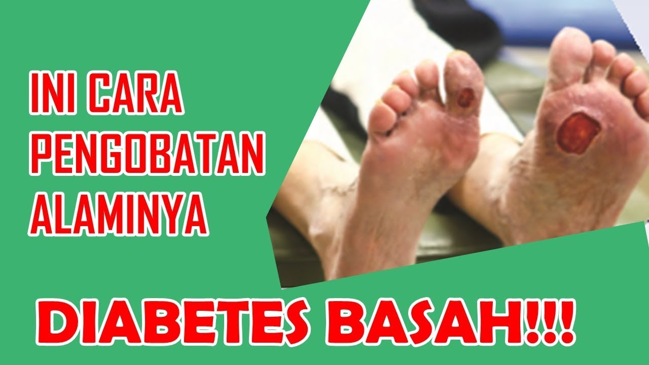 Pengobatan Diabetes Basah, Obat Diabetes Alami 