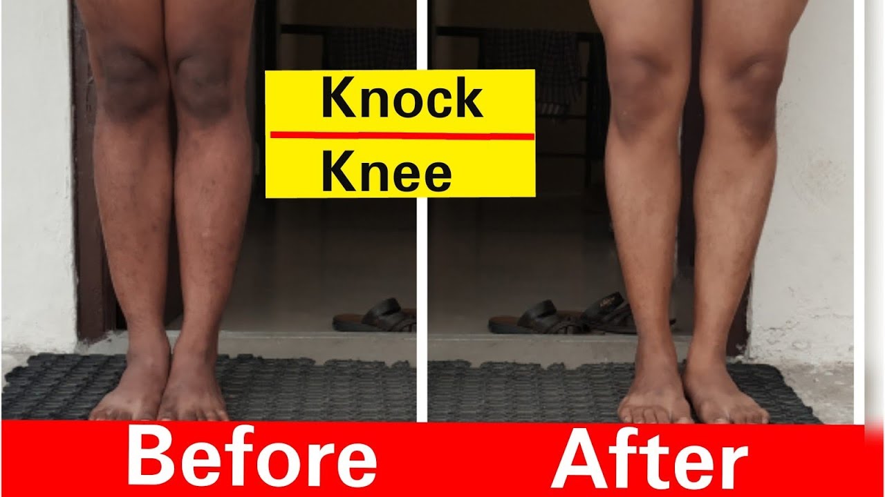 SSC GD Knock Knee घुटनों के दोष से छुटकारा का Latest Video 2018 YouTube