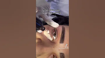 احدث تقنيه في العالم للتخلص من الهالات السمراء كاموفلاج هالات تصبغات 