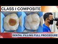 Dental Filling Full Procedure Class I Composite | General Dentist Griya RR