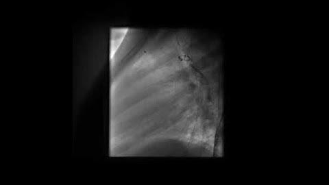 PDA Coil Closure  Post coil closure aortogram