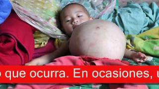 Niña Lleva Un Año Y Medio Con Su Hermano Dentro Del Su Estomago Niña Lleva Un Año Y Medio Con Su Hermano Dentro Del Su Estomago