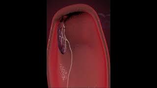 Placenta Delivery  ( 3D Animation)