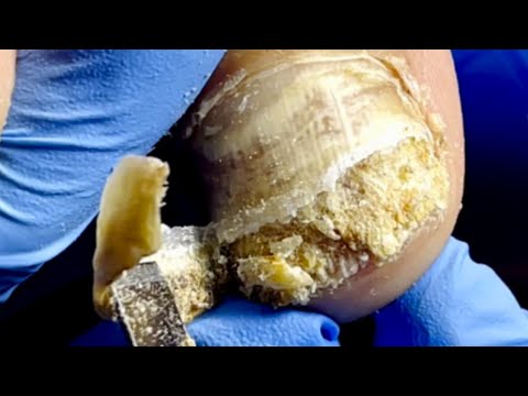 There Are Impurities Inside The Onychomycosis, So Clean It Thoroughly【Pedicure Master Lin Jun】 There Are Impurities Inside The Onychomycosis, So Clean It Thoroughly【Pedicure Master Lin Jun】