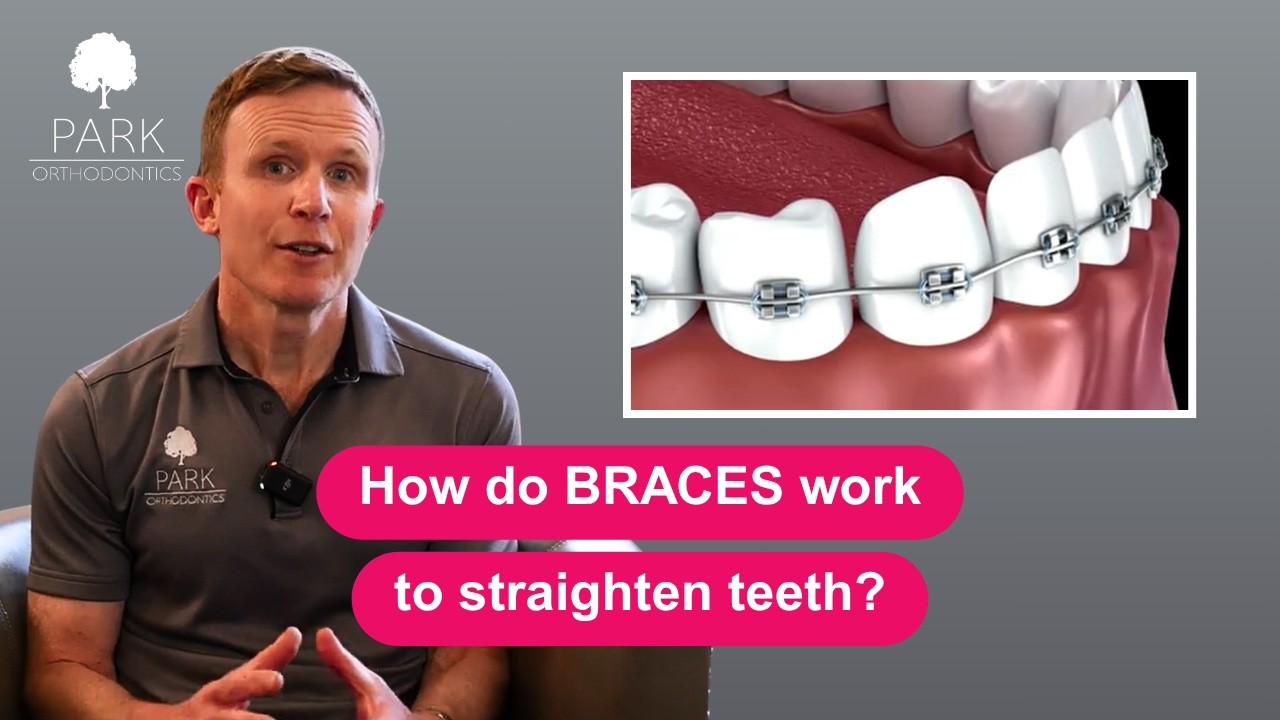 How do BRACES work to straighten teeth? - YouTube