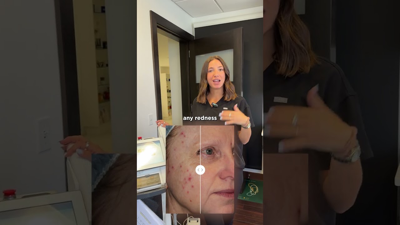 BBL Forever Clear for Acne | Dr. Garramone