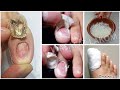 Do you suffer from nail fungus? You have to do this!!!! *** VERY IMPORTANT TIP ***