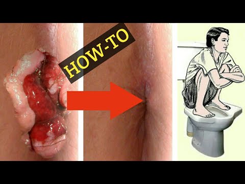 how-to-squat-on-a-toilet-to-prevent-or-shrink-hemorrhoids-|-natural-home-remedies-for-hemorrhoids