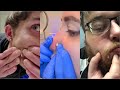 Popping huge blackheads and pimple popping  best pimple poppings 21