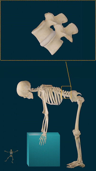 Hernia discal