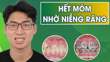 Hết khớp cắn ngược nhanh chóng nhờ niềng răng | Niềng răng ( Chỉnh nha )  gặp những khó khăn gì ?