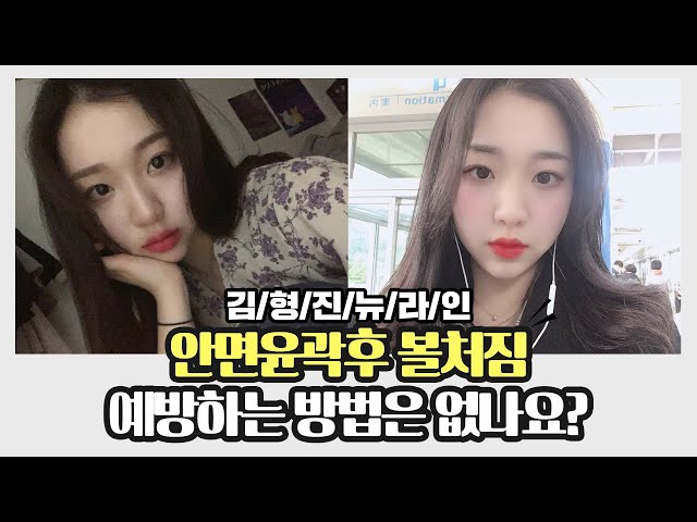 안면윤곽 vs 심부볼지방제거 4탄🔥 [안면윤곽후볼처짐 예방법]