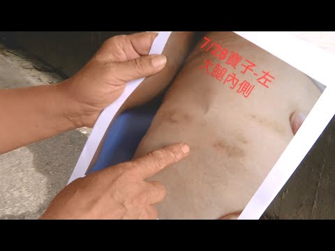 阿嬤身上瘀傷多 家屬質疑長照中心虐待 20200827 公視晚間新聞