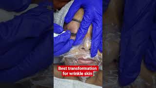 Best transformation for wrinkle skin ✨️ #shots #skincare #transformation #beauty  #fibroblasts
