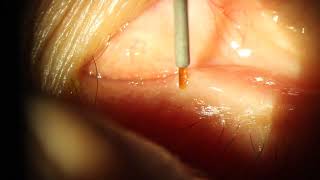 Oasis Form Fit Hydrogel Canalicular Punctal Plug Insertion screenshot 2