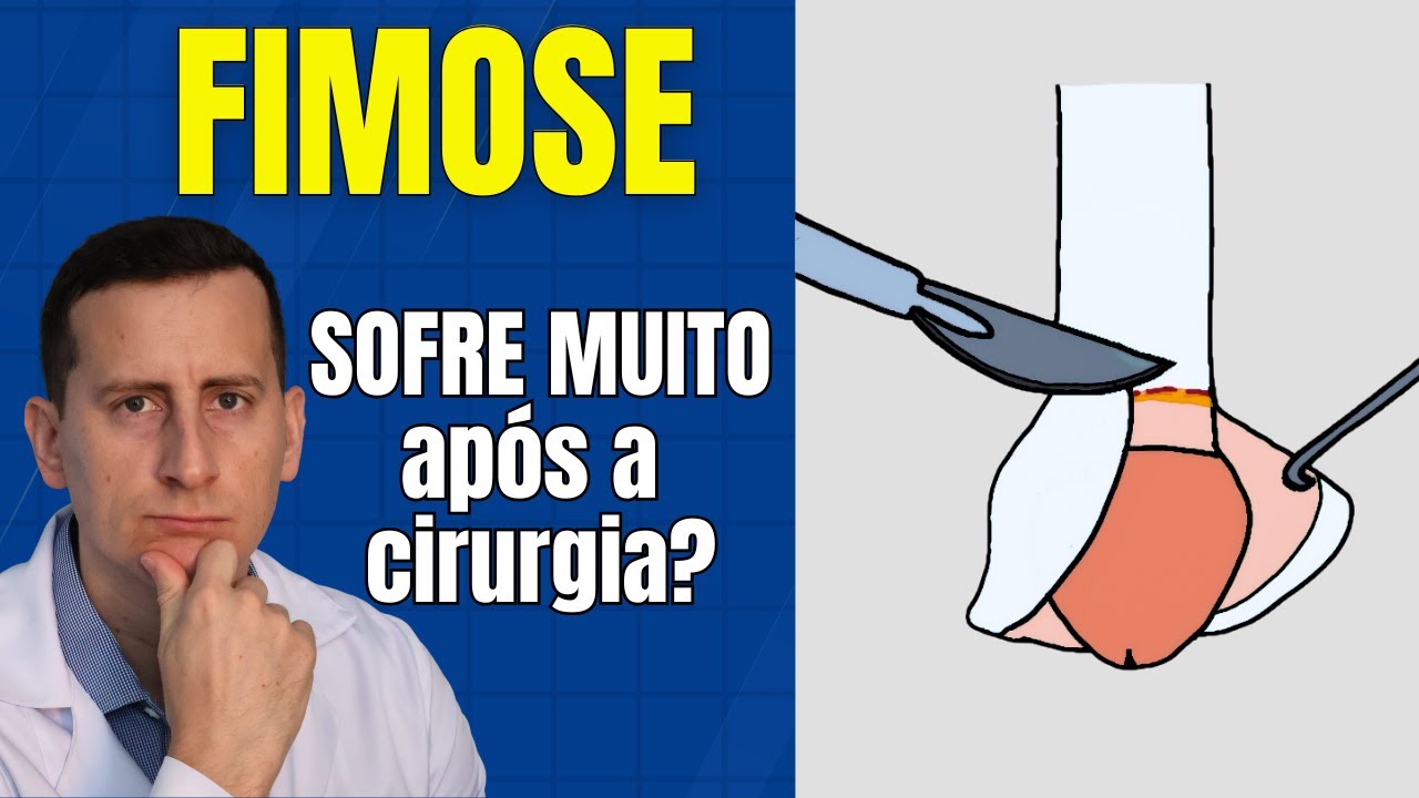 Cirurgia de FIMOSE (Postectomia):  A primeira semana é tão ruim assim? Como é após a cirurgia?